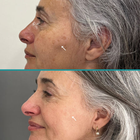 El proceso suele requerir tres sesiones, una al mes, para actuar en las diferentes capas cutáneas