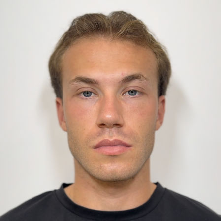 Resultado en un paciente del tratamiento de neuromodeladores del doctor Rafael Fernández