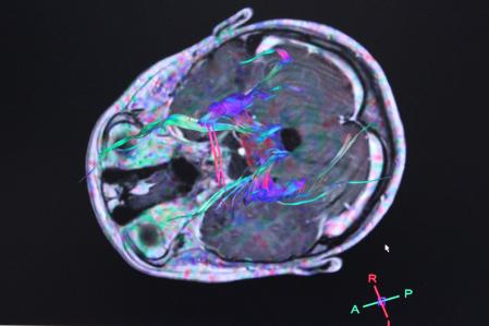 Radiografía de un cerebro