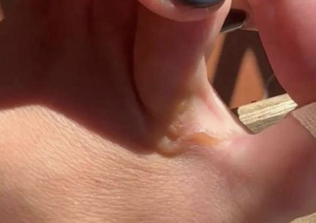 Una 'larva migrans' en el pie de Lucía Pombo