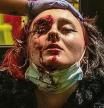 Mujer herida en el ojo presuntamente por un disparo de los Mossos durante las protestas en Barcelona por el encarcelamiento de Pablo Hasél. Finalmente perdió el ojo.