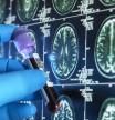Un análisis de sangre obtiene resultados equivalentes a las técnicas de neuroimagen para el diagnóstico del alzhéimer