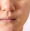 Allergic women have eczema dry nose and lips on winter season closeup.