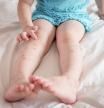 Mosquito bites sore and scar on child legs sitting on bed