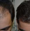 INJERTO CAPILAR ANTES Y DESPUES TRASPLANTE DE PELO TECNICA DHI DHI BARCELONA CLINICA