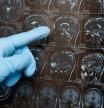 El dedo señala la imagen de un cerebro afectado por Alzheimer