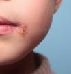 Impétigo, una infección bacteriana muy contagiosa