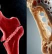 “El 80% de las personas con osteoporosis no están diagnosticadas, un drama”: síntomas y efectos del ‘ladrón de huesos’