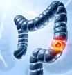 El cáncer de colon es uno de los que tienen más incidencia en España