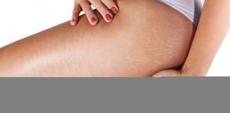 Piernas con estrías