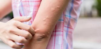 ¡No te rasques más! 5 productos eficaces para calmar las picaduras de mosquitos y otros insectos