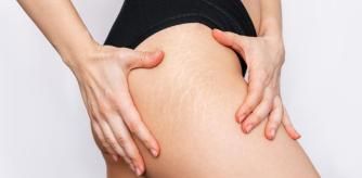 Una mujer con estrías en el muslo.