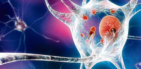 Representación de neuronas que contienen cuerpos de Lewy, pequeñas esferas rojas que son depósitos de proteínas acumuladas en las células del cerebro que causan el Partkinson