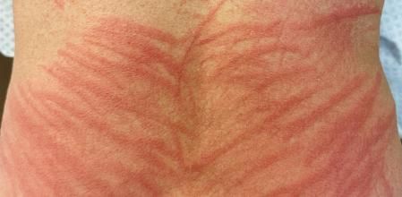 La dermatitis del shiitake se caracteriza por lesiones alargadas que parecen latigazos