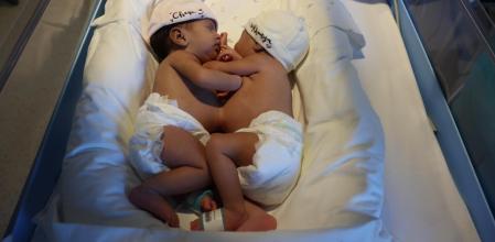 dos siamesas en sant joan de déu