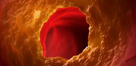 Acumulación de colesterol (en amarillo) en la pared interior de una arteria