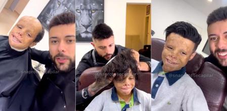 Un hombre implanta cabello a niños que han sufrido accidentes graves.