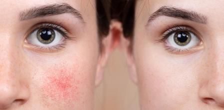 A young Caucasian girl shows the before and after results of intensive light surgery to remove the symptoms of rosacea. Noticeable reduction in cheens