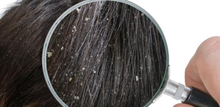 Una imagen aumentada del pelo de una persona con caspa.