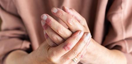 Una persona con las manos llenas de rojeces.