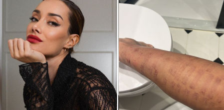 Adara Molinero muestra la evolución de sus quemaduras.