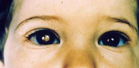 Una madre detecta el extraño cáncer de su hijo gracias al flash de su móvil