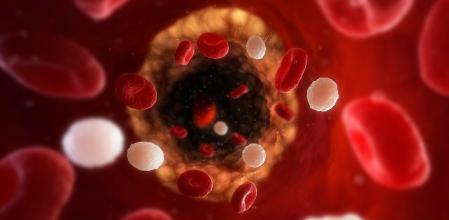 Imagen virtual del interior de una arteria humana parcialmente bloqueada por una placa de ateroma (amarilla)