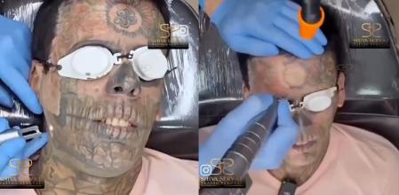 Leandro de Souza está eliminando los tatuajes de su cuerpo