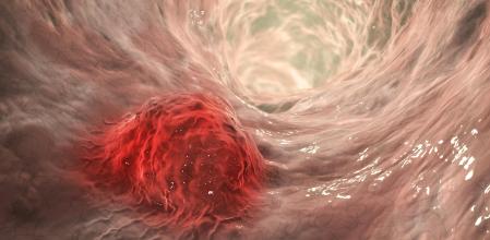 Ilustración de un tumor en el colon