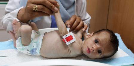 Una infermera examina un nen malnodrit a l'hospital de Khan Yunis, al sud de la franja, el passat dia 25 