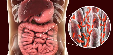 El tratamiento del SIBO debe ser interdisciplinar e ir acompañado de una dieta
