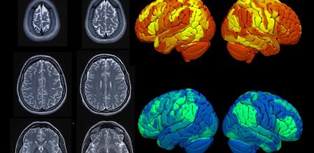 Desarrollan cuatro unidades especializadas: Epilepsia, Cefalea, Deterioro Cognitivo y Enfermedades Neuromusculares