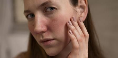 Una chica con rosácea en la zona de las mejillas y nariz