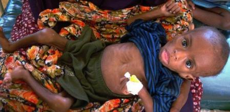 Un niño somalí a la espera de ser atendido en el hospital de Banadir, en el sur de Mogadiscio
