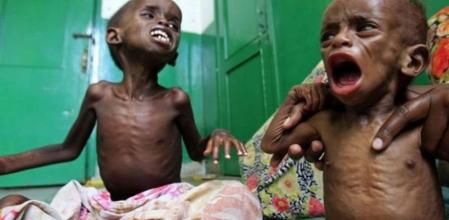 Niños somalís desnutridos en el hospital Banadir de Mogadiscio (Somalia)