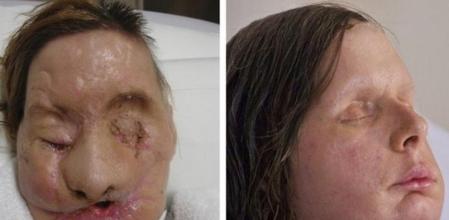 Combo de tres imágenes, que muestra a Charla Nash, víctima del ataque de un chimpancé, antes del accidente, (i), tras el ataque, (c), y después de someterse a una reconstrucción facial, en el hospital Brigham and Women de Boston, Estados Unidos. Las imágenes muestran el proceso de transformación facial de Nash quien recibió un transplante de rostro en el mes de mayo