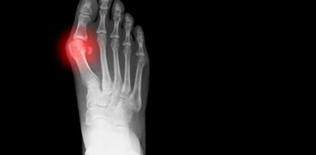 El reuma afecta a una de cada cuatro personas