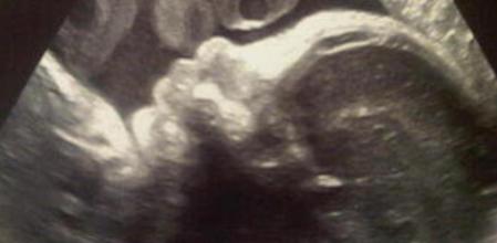 Ecografía que Piqué ha colgado en las redes sociales de su hijo