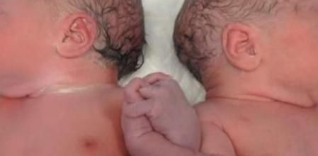 Dos mellizos que se dan la mano al nacer enternecen a todo un hospital