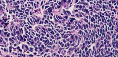 Células cancerígenas de pulmón.