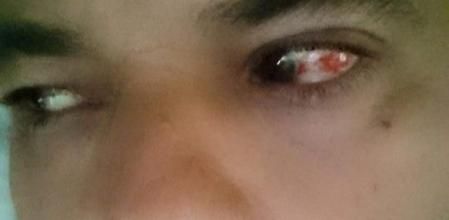 Frank Cuesta, herido por el veneno escupido de una serpiente, se ha recuperado de las heridas en la cara