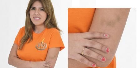 Isa Pantoja, con un moratón en el brazo izquierdo durante una sesión de fotos antes de 'Supervivientes'