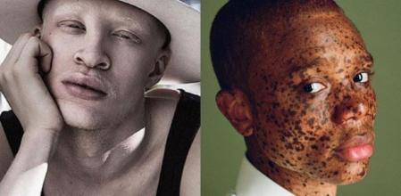 El modelo albino Shaun Ross, a la izquierda, y una de las personas que se ha unido a la causa