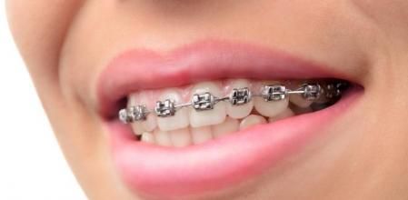 Una chica con los brackets&nbsp;