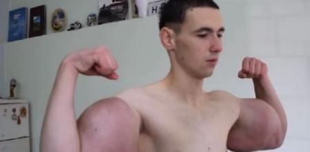 Kiril Tereshin, el 'popeye ruso', se opera para reducir sus brazos