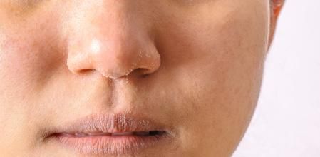 Allergic women have eczema dry nose and lips on winter season closeup.