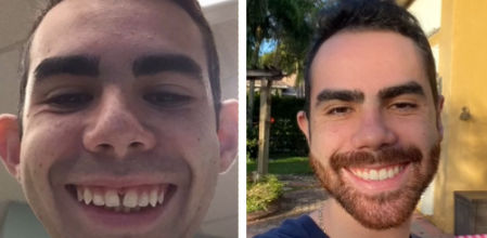 El antes y el después de Hunter David tras nueve operaciones