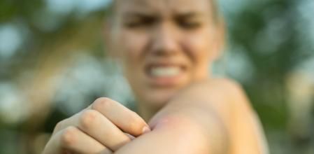 Picadura de mosquito.