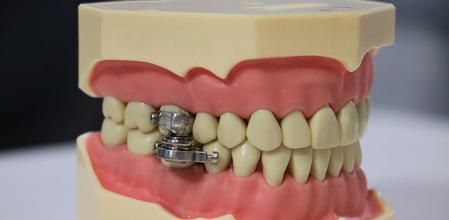 Polémico método contra la obesidad: un candado en la dentadura que impide ingerir alimentos sólidos