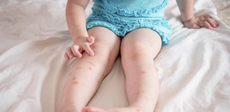 Mosquito bites sore and scar on child legs sitting on bed